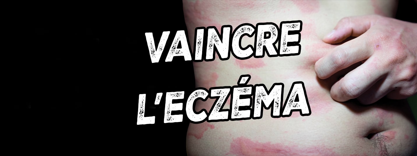 Soigner l'Eczema